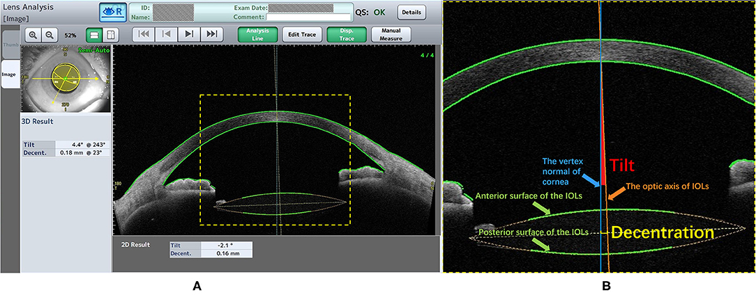 Here are a few options for rewriting the title as a news article title within the word limit:
Option 1 (Focus on Improvement):

New Lens Design Enhances Eye Stability, Scans Show

Option 2 (Focus on Haptic Design Importance):

Haptic Lens Design Key to Eye Implant Stability: Study

Option 3 (More Direct & Concise):

Lens Haptic Design Impacts Eye Stability: Scan Study

Option 4 (Highlighting Scan Technology):

Advanced Scans Reveal Eye Lens Stability Based on Design

Option 5 (Shortest & punchy):

Haptic Lens Design Boosts Eye Stability: Scan Findings

Considering the request for a news article title and aiming for conciseness and impact,  Option 5 seems to be the most effective and fits within the 13-word limit.
Final Answer (Option 5):

Haptic Lens Design Boosts Eye Stability: Scan Findings